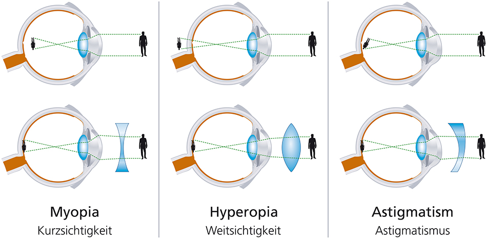 Fehlsichtigkeiten: Myopie, Hyperopie, Astigmatismus